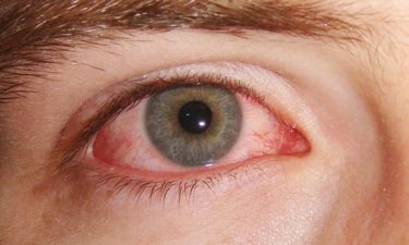Bindehautentzündung (Konjunktivitis)