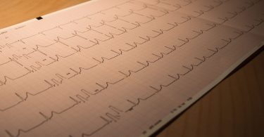 Ausgedruckter EKG-Streifen mit Herzstromkurven auf einem Holztisch